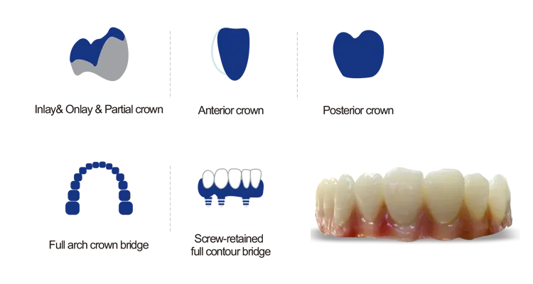 4D Plus multilayer zirconia blanks Applications: 4D Plus multilayer zirconia blanks Applications: